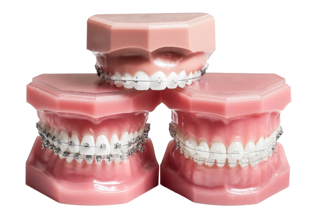 Appareils dentaires métalliques et céramiques
