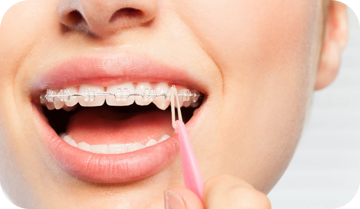 Port des élastiques en orthodontie